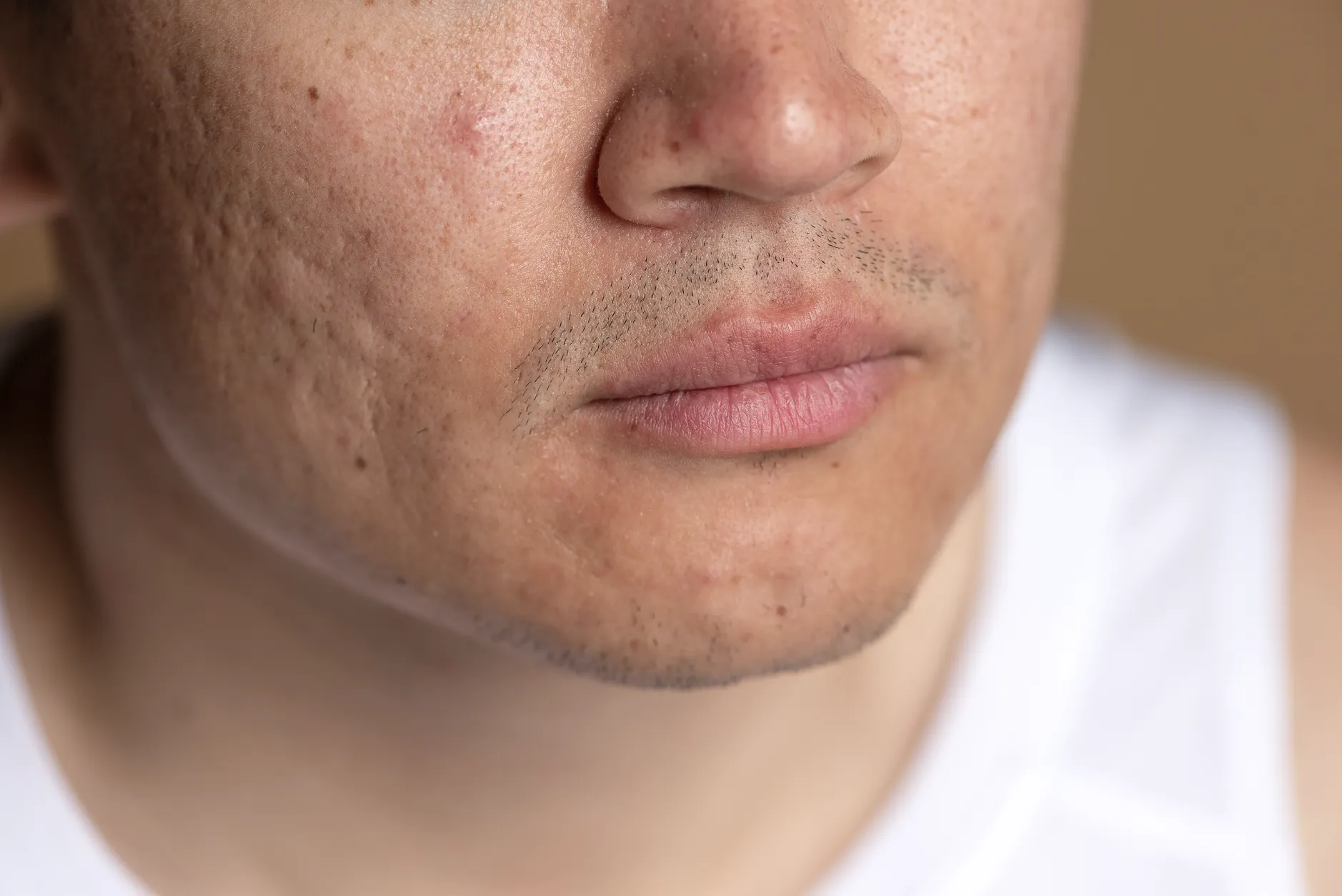 Rosacea treatment consultation in Ithaca NY dermatology office