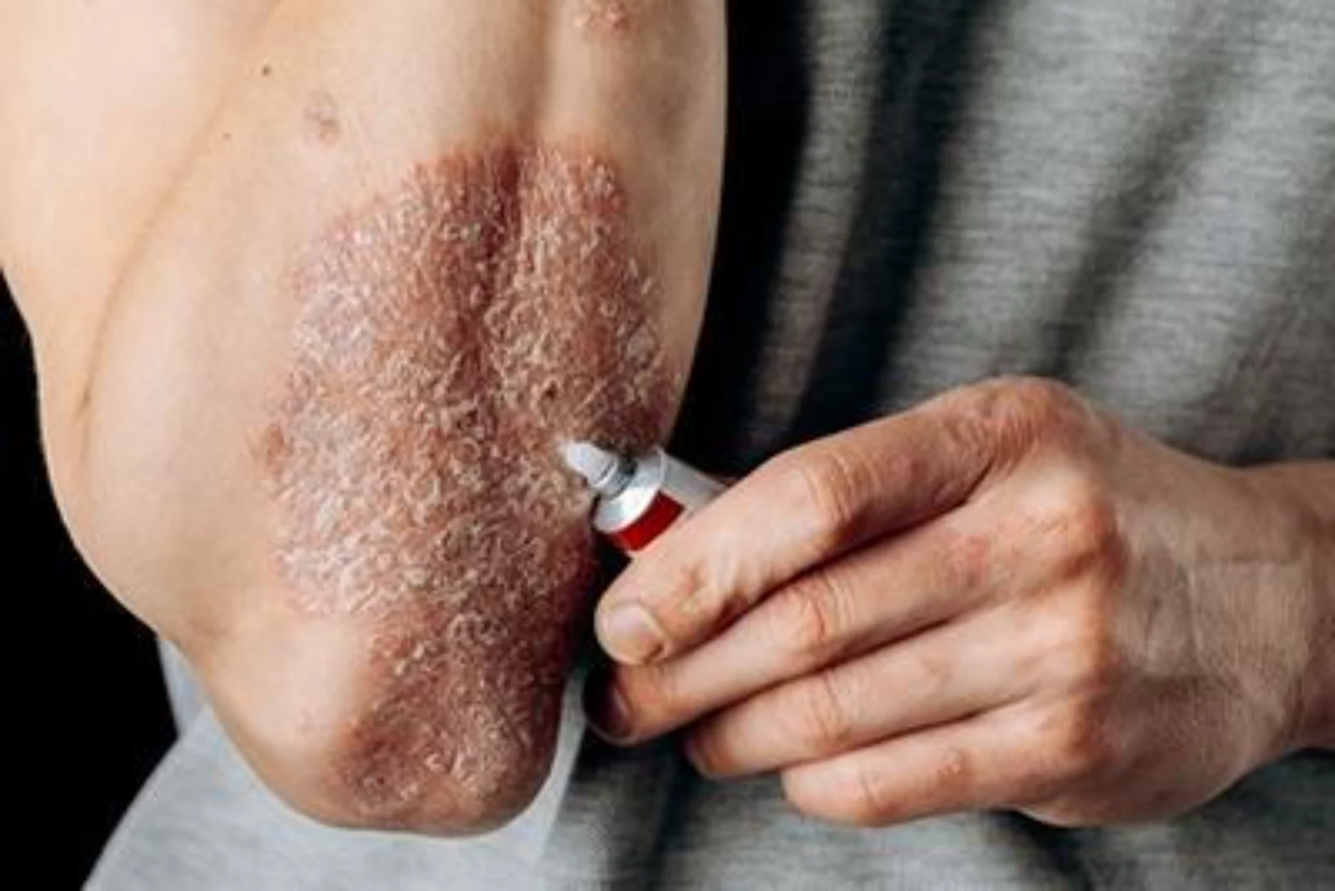 Severe dry skin treatment in Ithaca NY