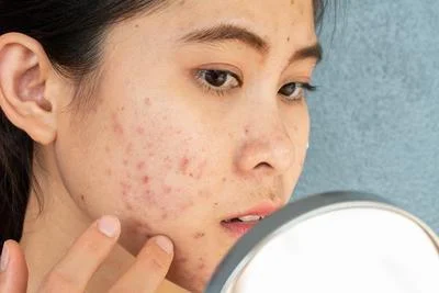 Acne management consultation in Cortland NY