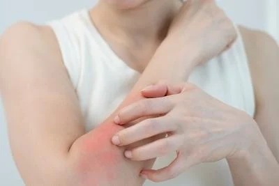 Eczema flare care in Cortland NY dermatology
