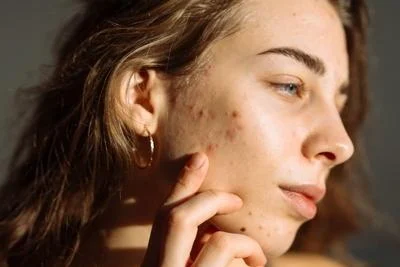 Facial acne treatment in Ithaca NY